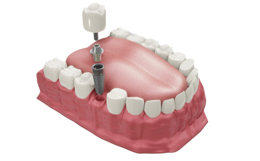 ราคารากฟันเทียมเริ่มต้น 32999 บาท รวมฝังราก-ครอบฟัน-Xray